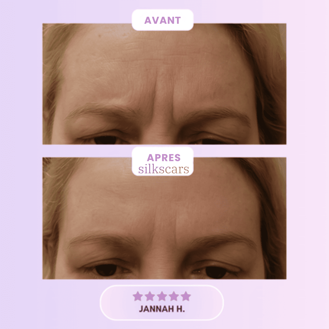 Silkscars Patch Anti‑Rides Collagène